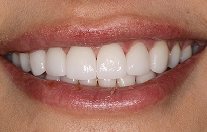 Smile after fixing several chipped teeth
