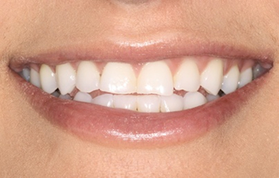 Smile with several chipped teeth