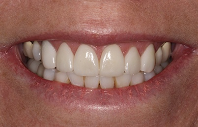 Smile after straightening and whitening the teeth