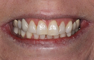 Smile with slightly misaligned and stained teeth