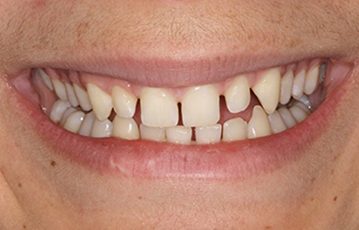 Smile with gapped and yellowed teeth