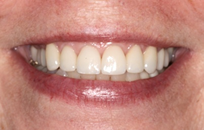 Smile with whiter and more evenly spaced teeth