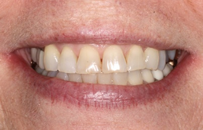 Smile with yellowed teeth and small gaps between some teeth