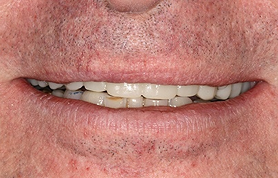 Man smiling with new, lifelike dental restorations