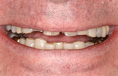 Man smiling with several damaged teeth and gold crowns
