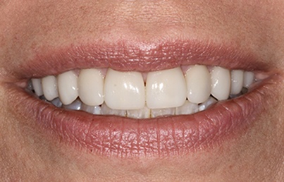 Smile after removing the stains from the teeth