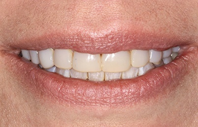 Smile with yellow stains on several teeth
