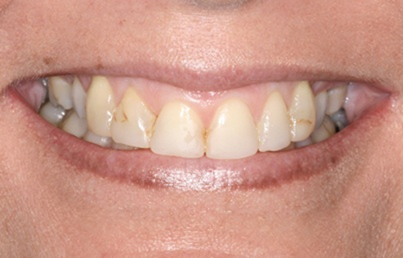 Smile with misaligned, damaged, and discolored teeth