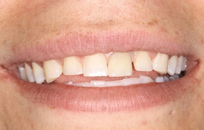 Smile with worn and stubby teeth