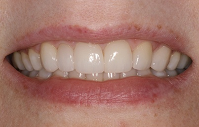 Smile after treating worn and gapped teeth