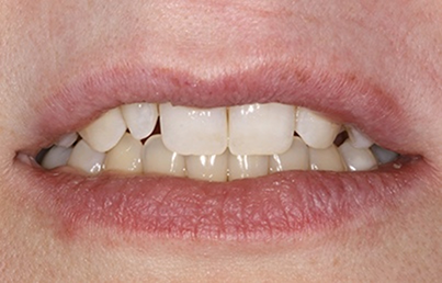 Smile with slightly worn and gapped teeth