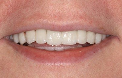 Smile after treating yellow discoloration on the teeth