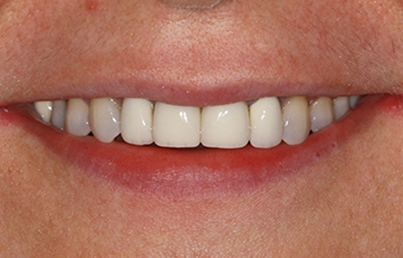 Smile with yellow discoloration on some teeth