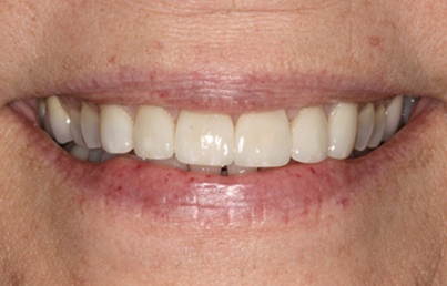 Smile after fixing worn and slightly yellowed teeth