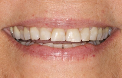 Smile with worn and slightly yellowed teeth