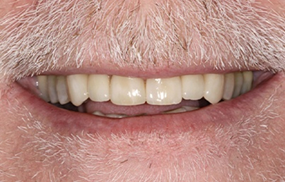 Man smiling with a newly restored set of flawless teeth