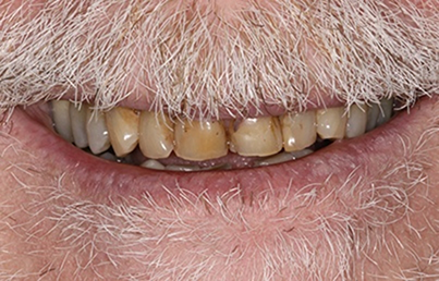 Man smiling with severely damaged and discolored teeth