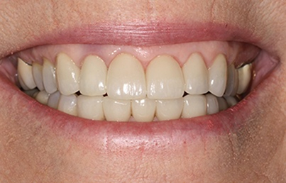 Smile after fixing the dark yellow discoloration on the teeth