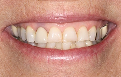 Smile with dark yellow discoloration on the teeth