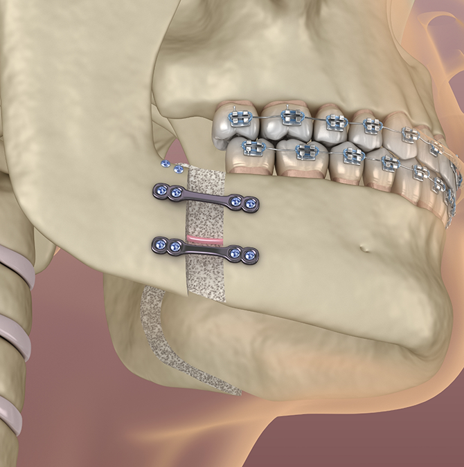 Illustration of the jawbone being adjusted