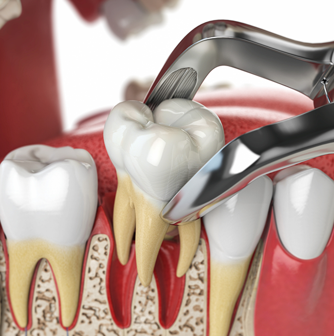 Illustration of forceps extracting a tooth