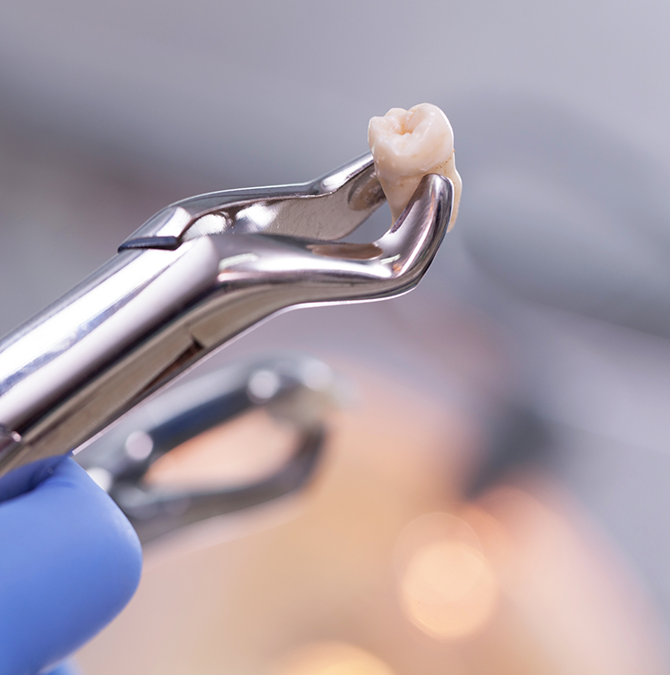 Forceps holding an extracted tooth