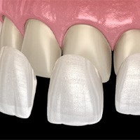 3D illustration of veneers in Bellingham  