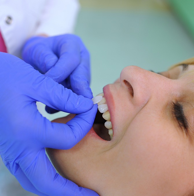 Dentist placing a veneer over a patient's tooth