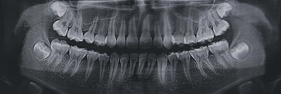 X-ray of a dental patient before getting wisdom tooth extractions in Bellingham