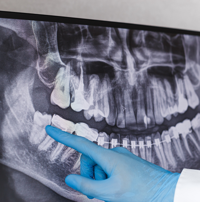 Dentist pointing to an x-ray of the teeth