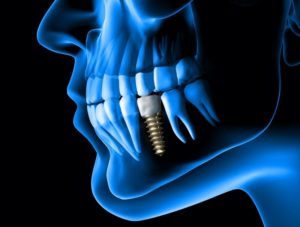 Dental Implant X-ray