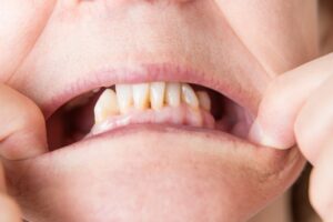 Person showing missing back teeth. 