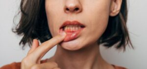 Woman showing gum disease. 