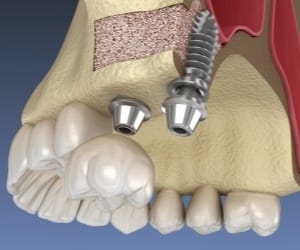 Model of implant posts in jawbone